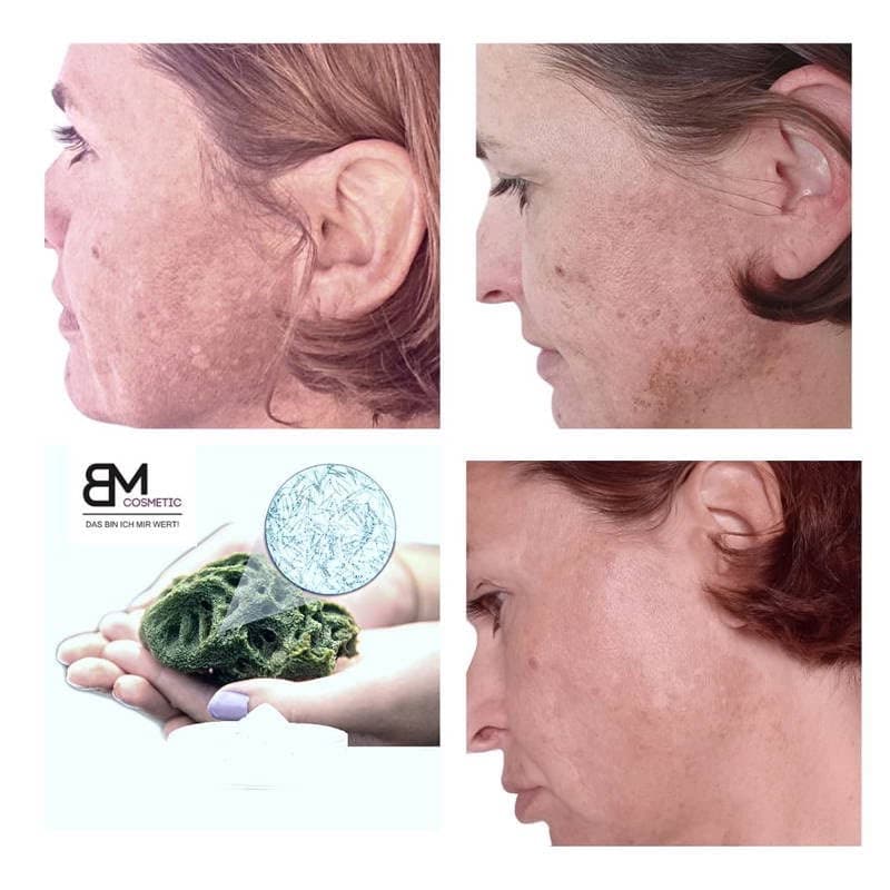Bio Microneedling Bremen Hautstruktur vorher nachher