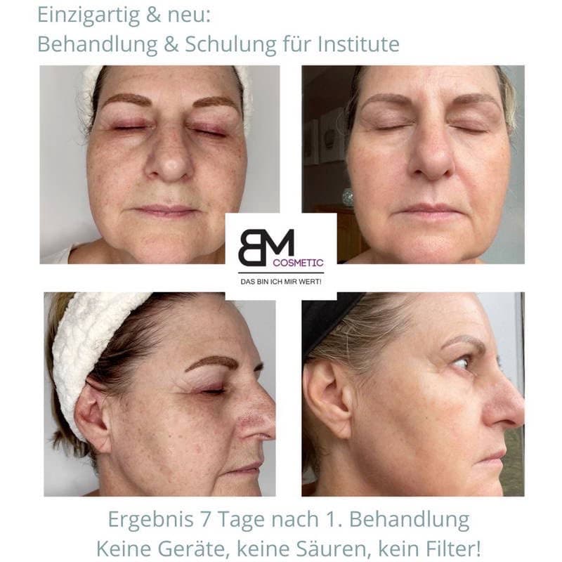 Bio Microneedling Bremen bei Pigmentierungen