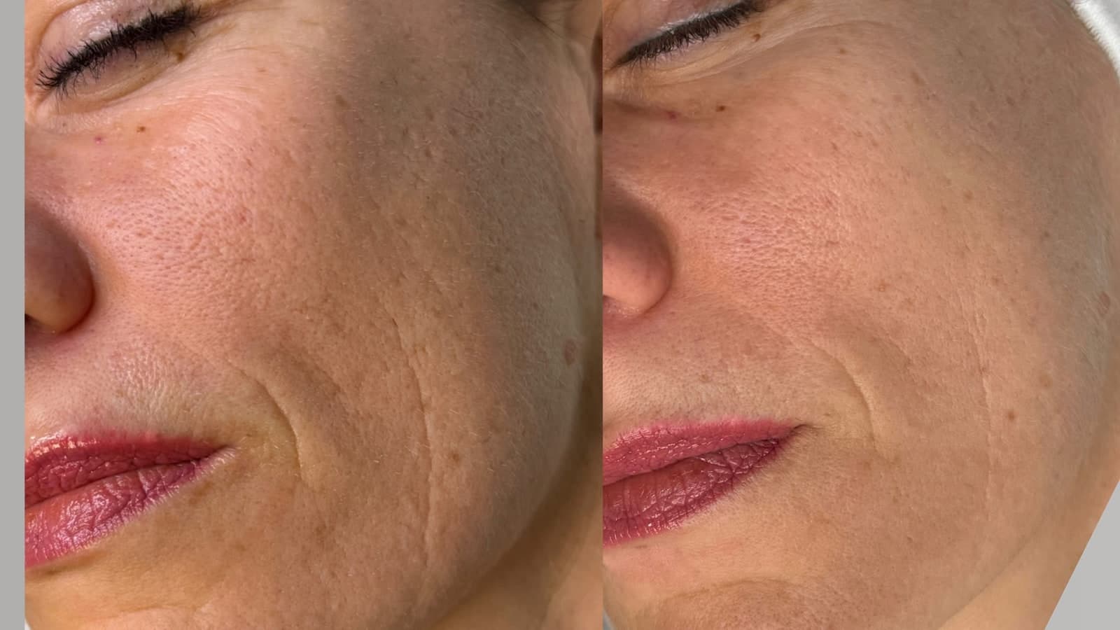 Medical Microneedling Ergebnis: Gesichtshaut vorher und nachher im Vergleich