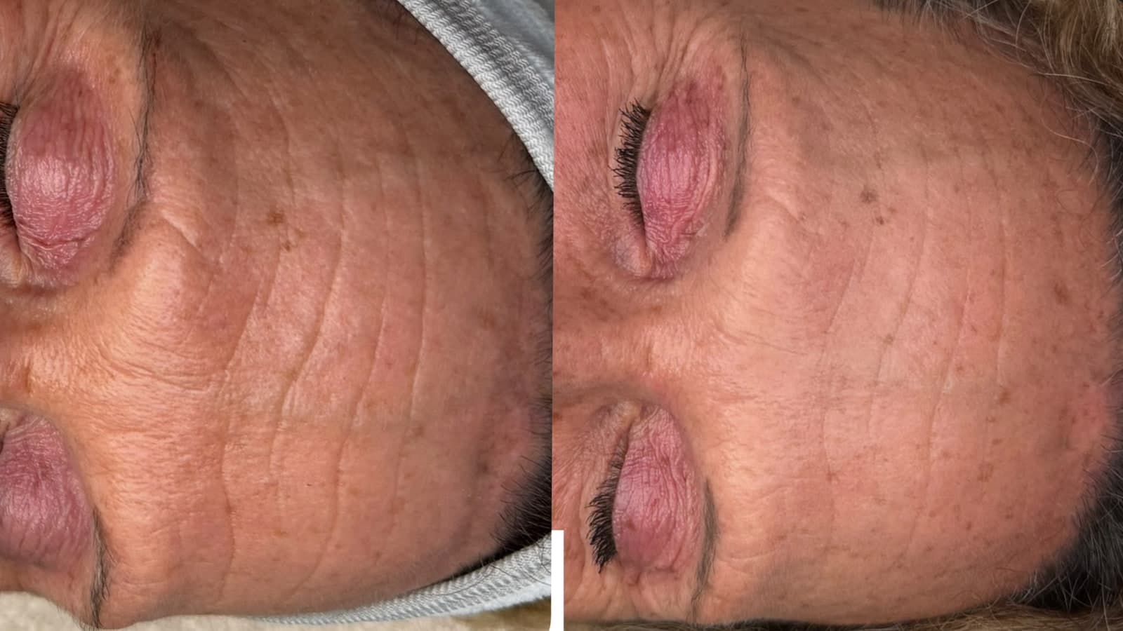 Medical Microneedling Ergebnis: Stirnpartie vorher und nachher im Vergleich