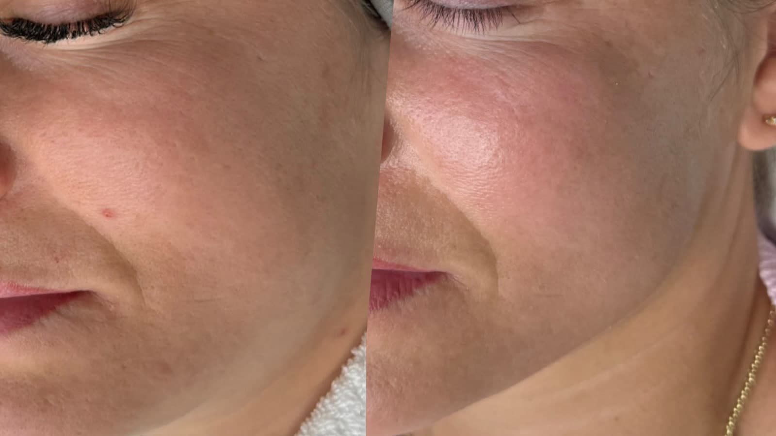 Medical Microneedling Ergebnis: Wange vorher und nachher im Vergleich
